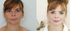 metamorfoza med-beauty, przed i po, before and after