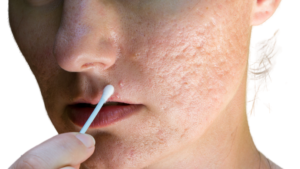 usuwanie blizn potradzikowych Med-beauty