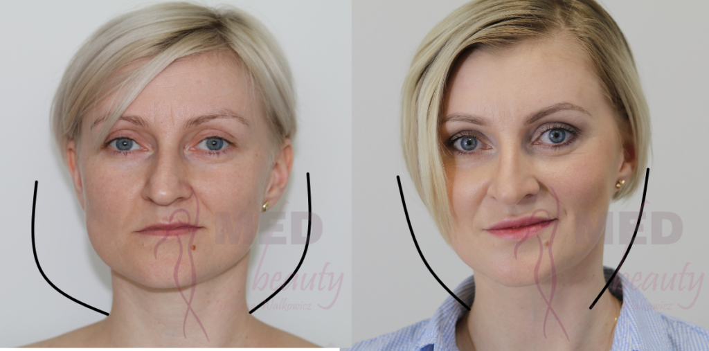 metamorfoza Med-beauty