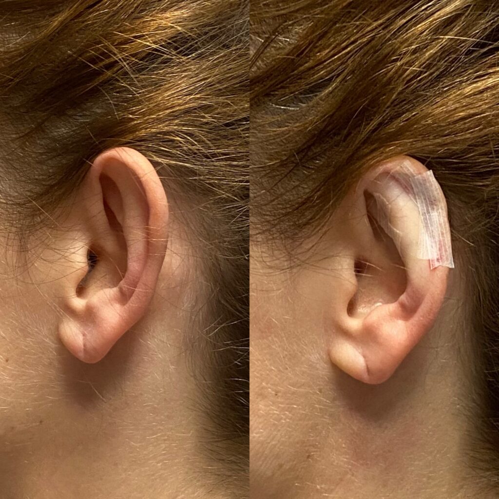Zabiegi na odstające uszy
